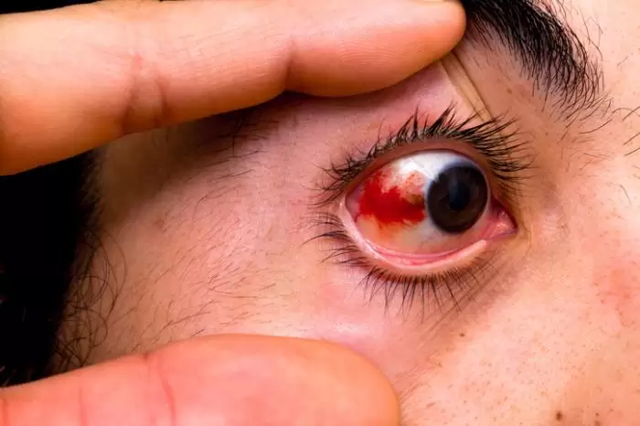 قرمزی چشم : علت، انواع و درمان آن